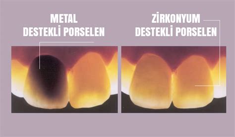  Zirkonyum Oksit: Seramiklerin Sıradışı Yıldızı ve Kimyasal Endüstrisinin Gizli Kahramanı mı?